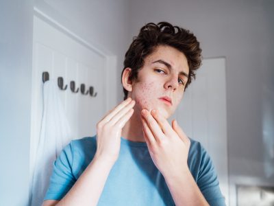 A young teenage boy looks in the mirror at his cystic acne scars, in hopes he can find a dermatology treatment to reduce scarring.