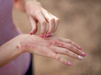 A woman scratches her hand during a severe outbreak of dry skin before attending a dermatologist appointment.