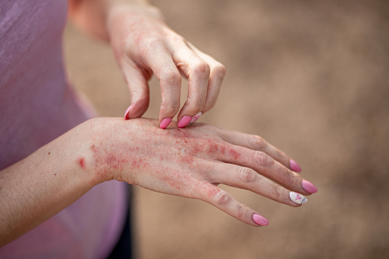 A woman scratches her hand during a severe outbreak of dry skin before attending a dermatologist appointment.