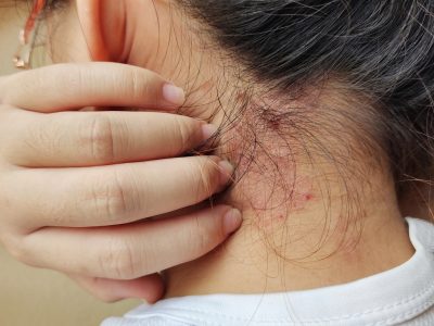A young woman scratches an eczema flare-up on the back of her neck.