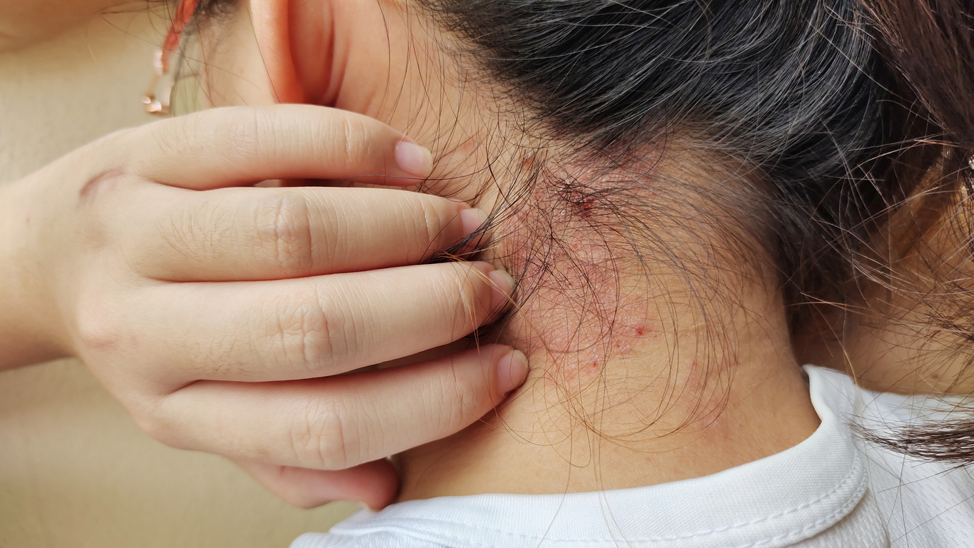 A young woman scratches an eczema flare-up on the back of her neck.