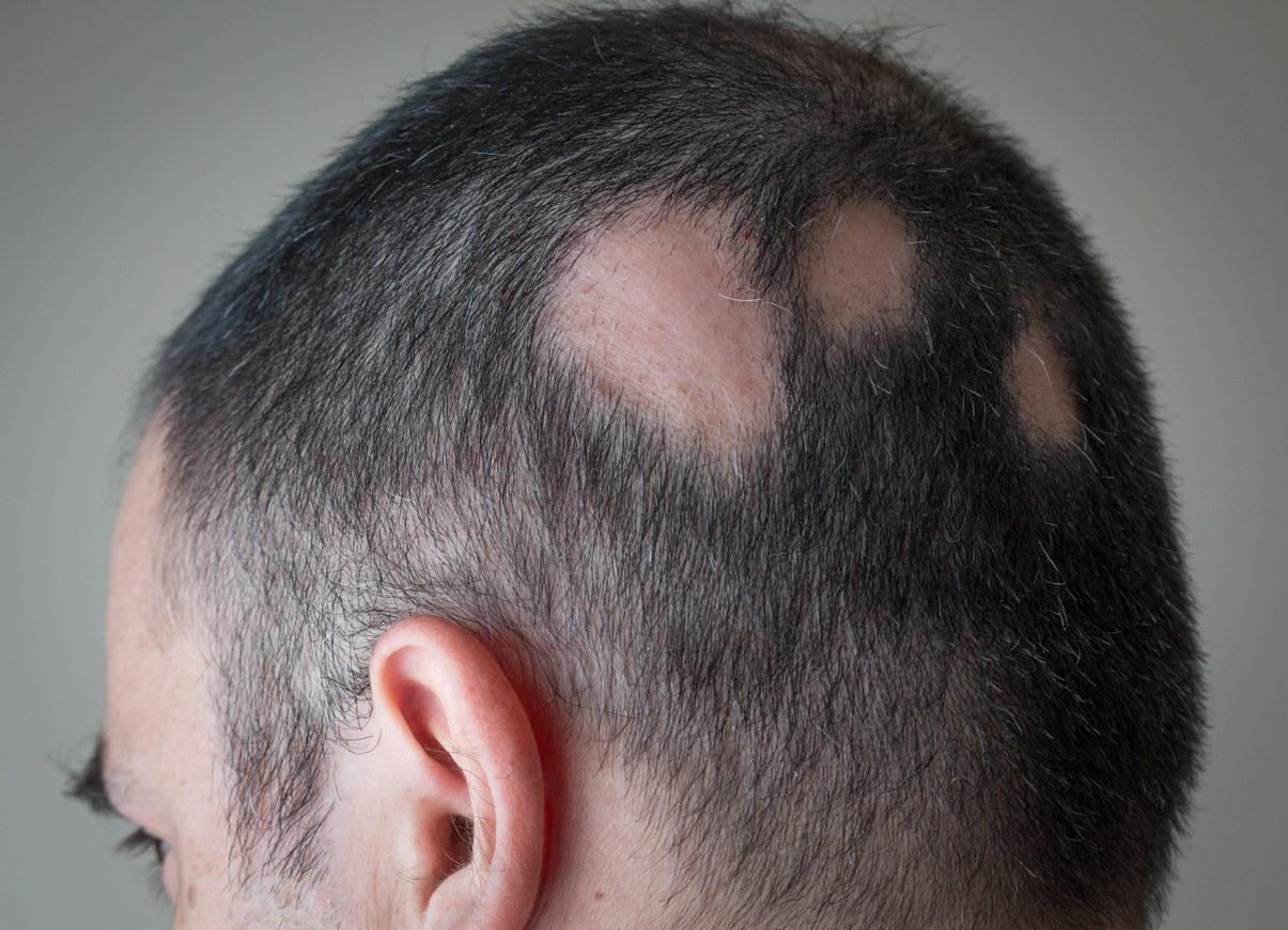 The back of a man’s head shows large bald patches, indicating signs of alopecia areata